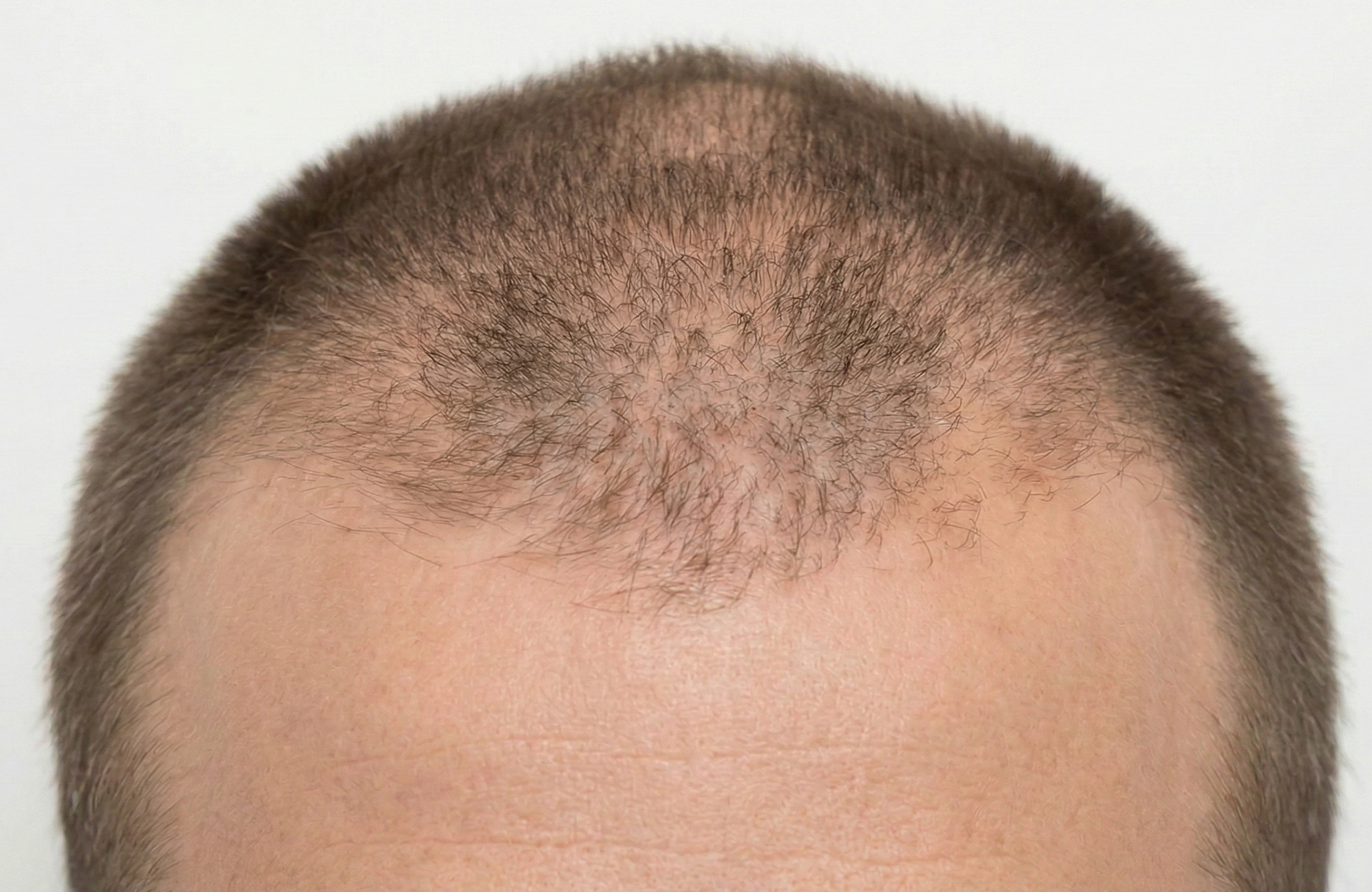 Antes do tratamento para queda de cabelo