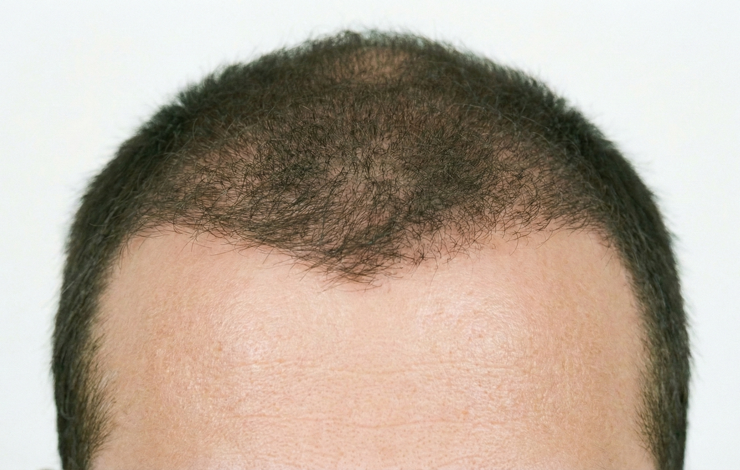 Depois de 6 meses de protocolo combinado com laser e suplementação